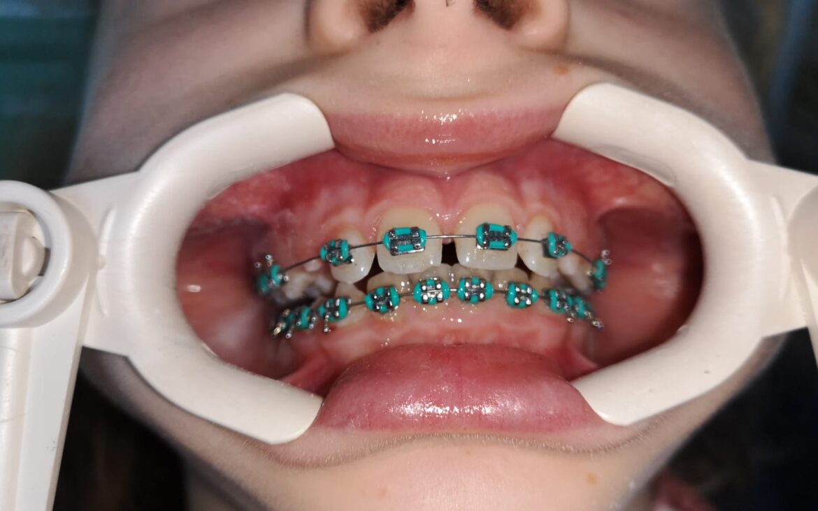 De ce poate fi placa bacteriană coșmarul oamenilor care poartă aparate dentare și al medicilor ortodonți
