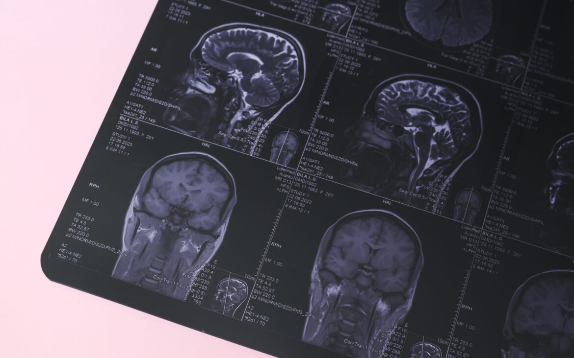 Diagnosticul greșit primit de un adolescent: Adevărul crunt din spatele unor migrene și atacuri de panică