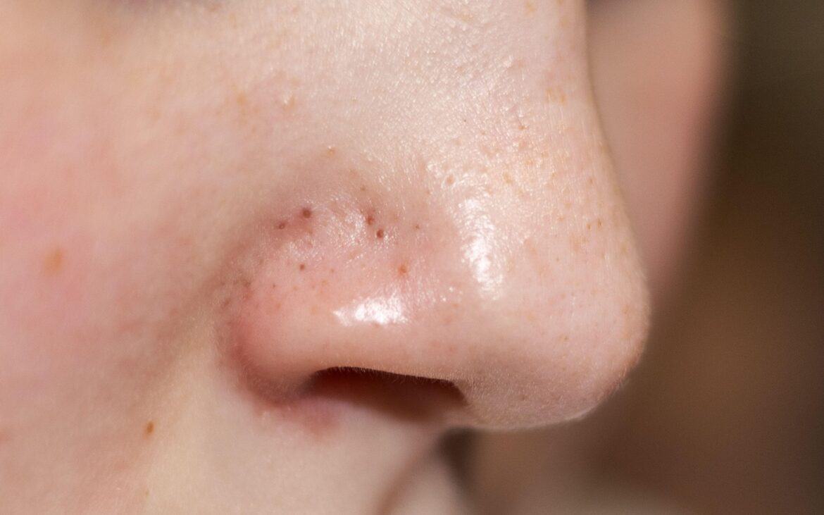 Tratamentul natural de 7 lei împotriva punctelor negre. Scapi de imperfecțiuni cu acest exfoliant preparat acasă