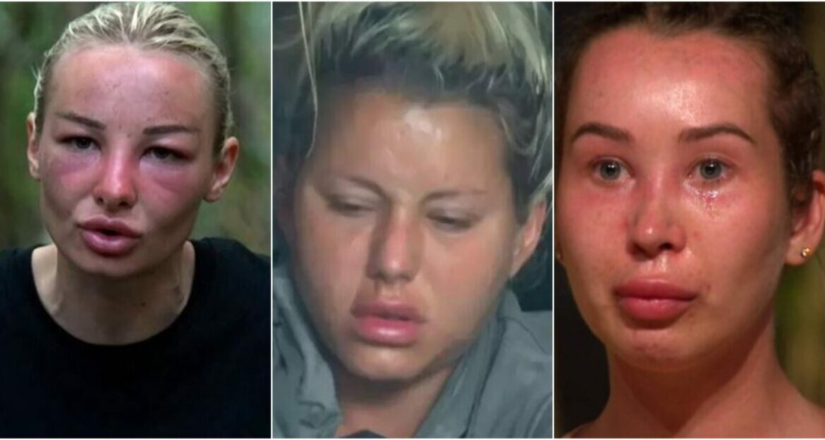 De ce li s-a umflat, de fapt, fața vedetelor de la „Survivor”? Adevărul din spatele transformărilor care au stârnit controverse