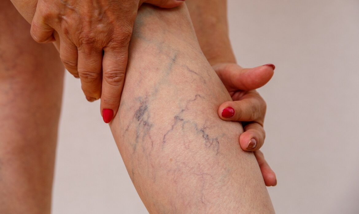 Scapă de varice cu un remediu natural care chiar funcționează