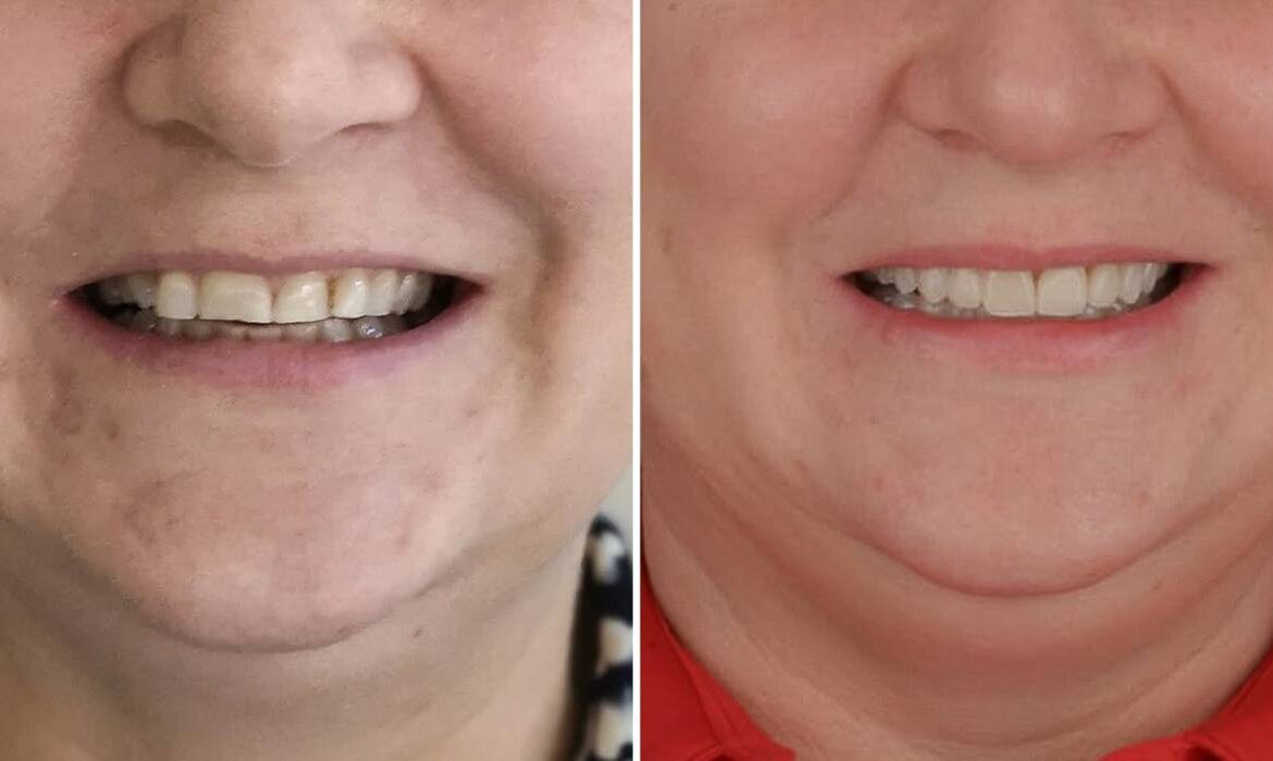 Când dinții nu mai stau la locul lor: de ce uneori ortodonția e esențială înainte de o lucrare dentară