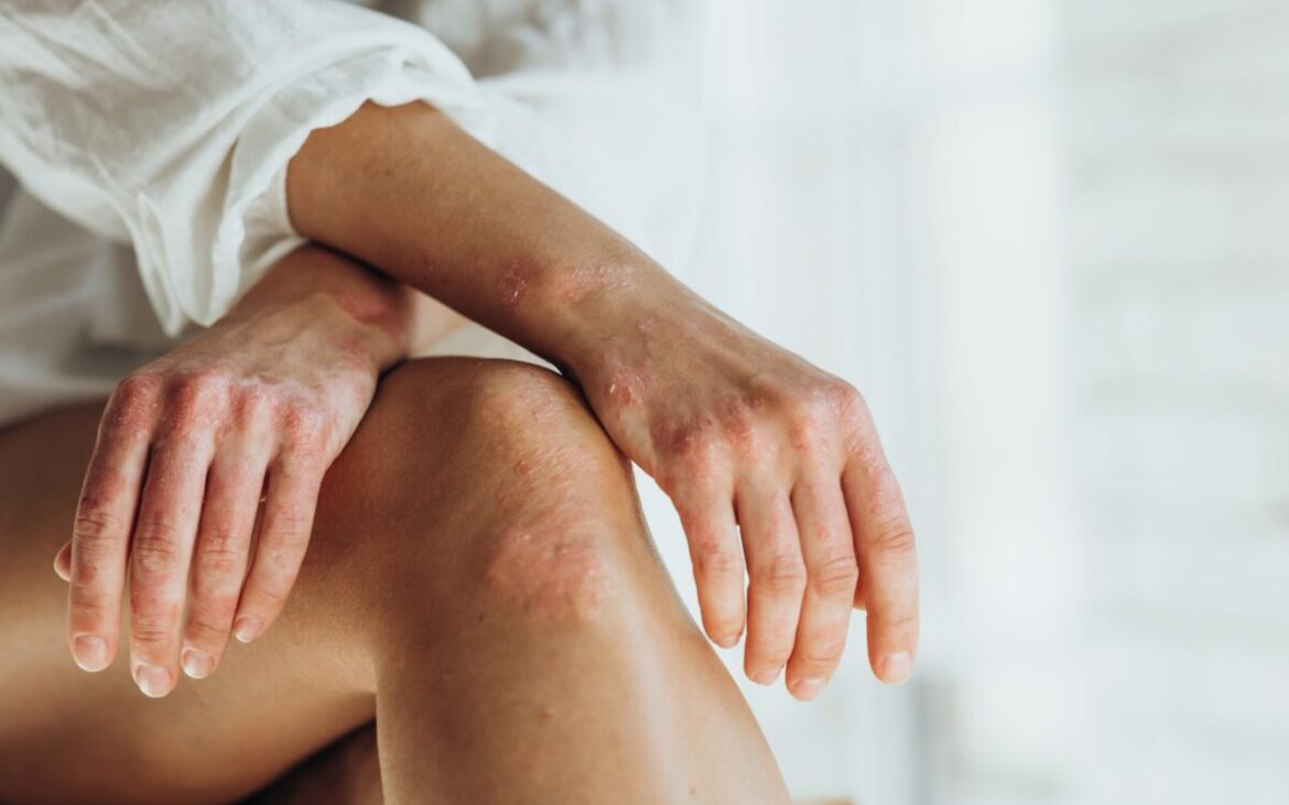 Remediu naturist împotriva psoriazisului: calmare și hidratare profundă cu ingrediente naturale