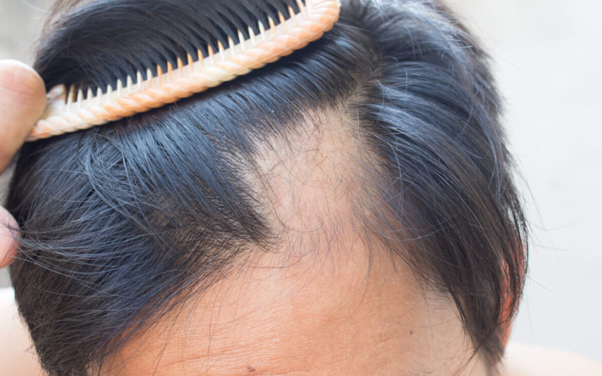 Părul tău merită mai mult: Dr. Diana Savu explică tot ce trebuie să știi despre alopecie și prevenție