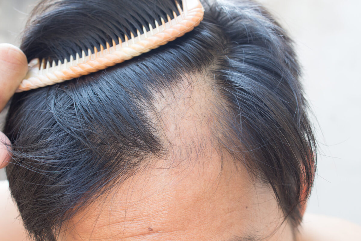 alopecie-scaled-e1761555538231.jpg