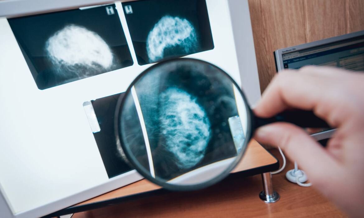 14 mituri și adevăruri despre cancerul mamar