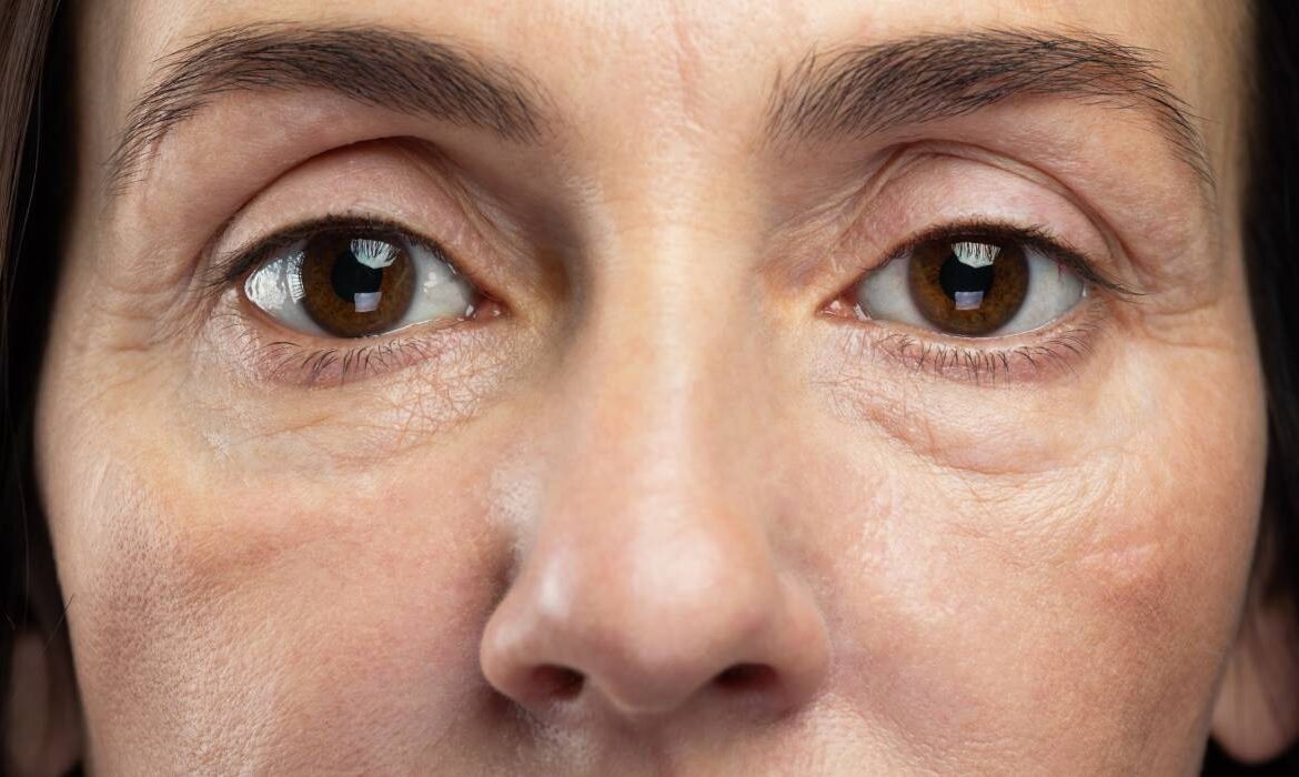 De ce părem obosiți și îmbătrâniți chiar dacă dormim suficient. Pielea din jurul ochilor, cea care ne trădează!