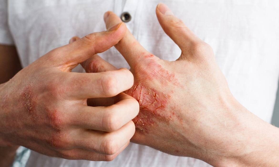 Cum își pot gestiona pacienții cu psoriazis simptomele în sezonul rece. Recomandările medicului dermatolog