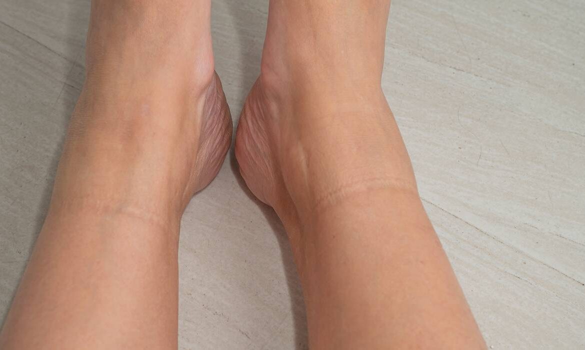 Dacă ai această linie pe picior suferi de boli cardiovasculare. Semne care trec neobservate, dar indică probleme serioase de sănătate