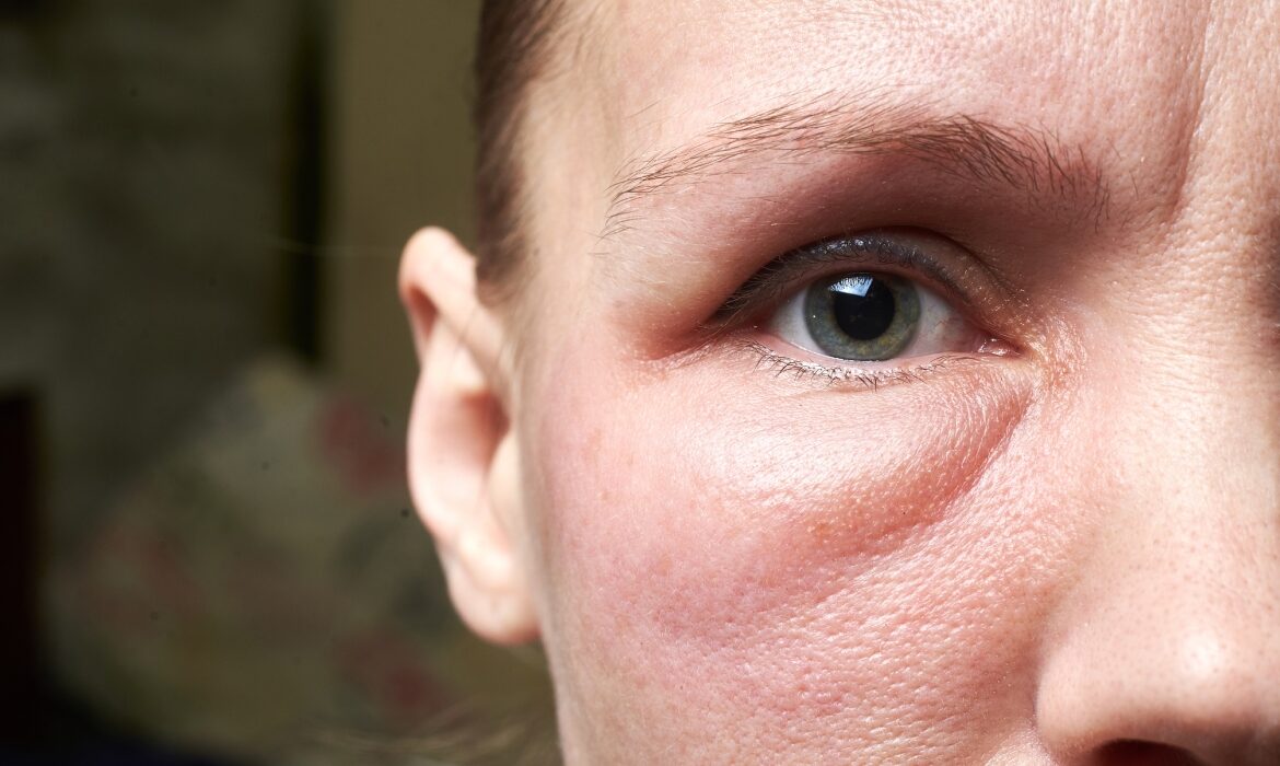 Semnele ascunse ale problemelor renale. Ce spun ochii umflați