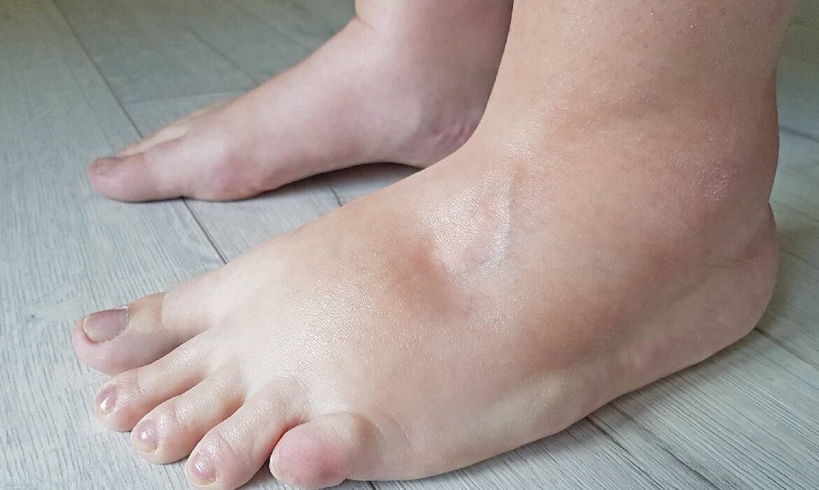 Corpul tău pare umflat fără motiv: adevărul despre retenția de apă