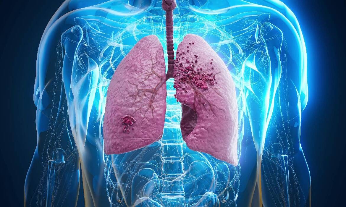 Mituri medicale despre cancerul pulmonar: ce este adevărat și ce nu