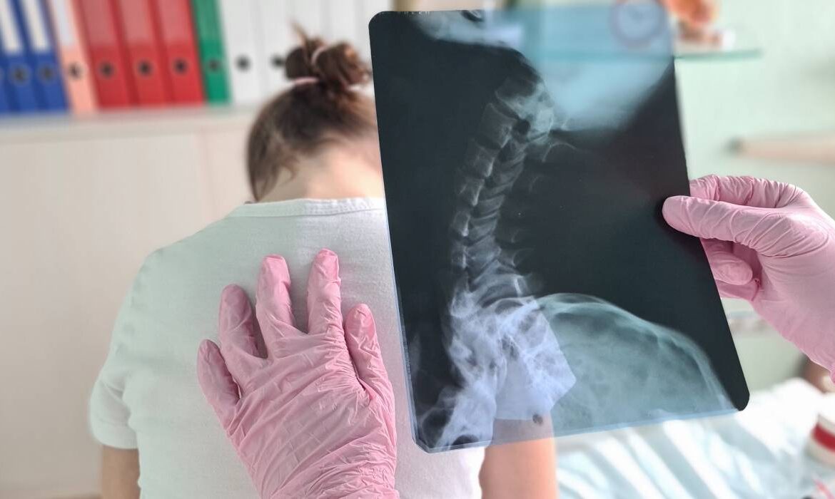 Cele 4 semne vizibile care pot indica scolioza la copii. Afecțiunea apare frecvent între 10 și 15 ani