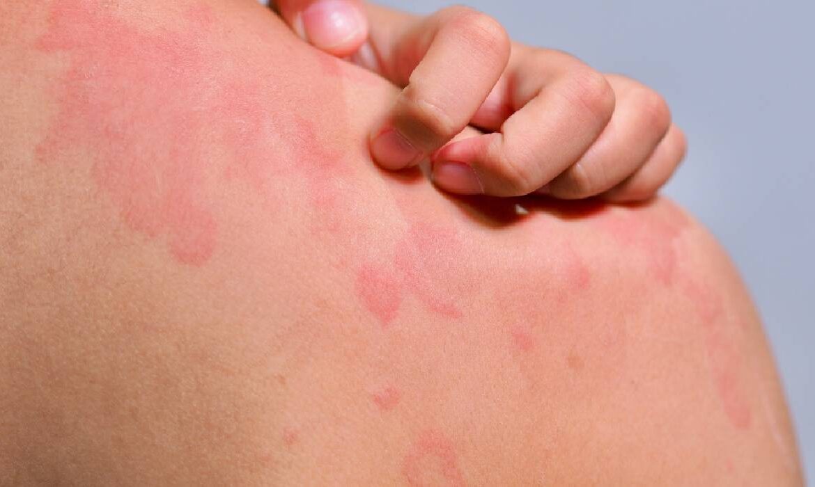 Urticaria cronică spontană: cât durează, de ce apare și când trebuie să mergi la medic